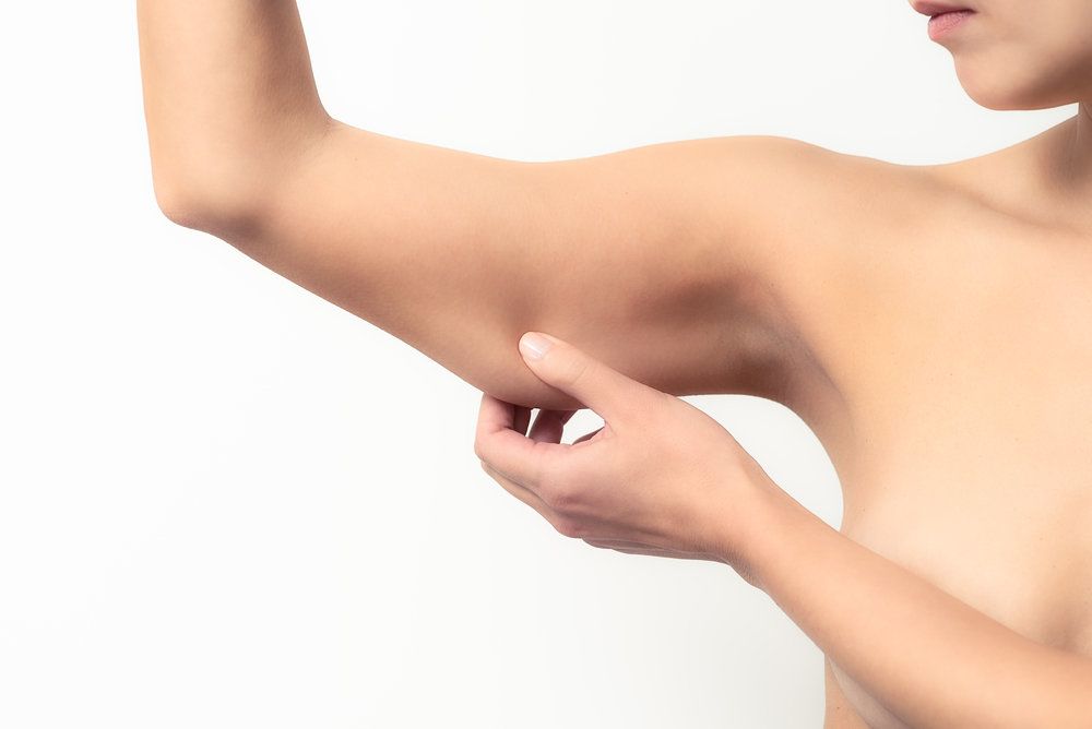 Woman pinching her excess upper arm skin.