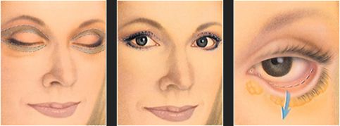 Stages of Eyelid Surgery