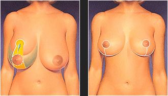 Breast Reduction illustration